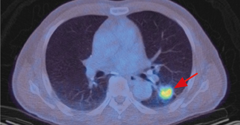 Lung cancer FSPG_grid